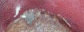 dental_calculus 2.jpg